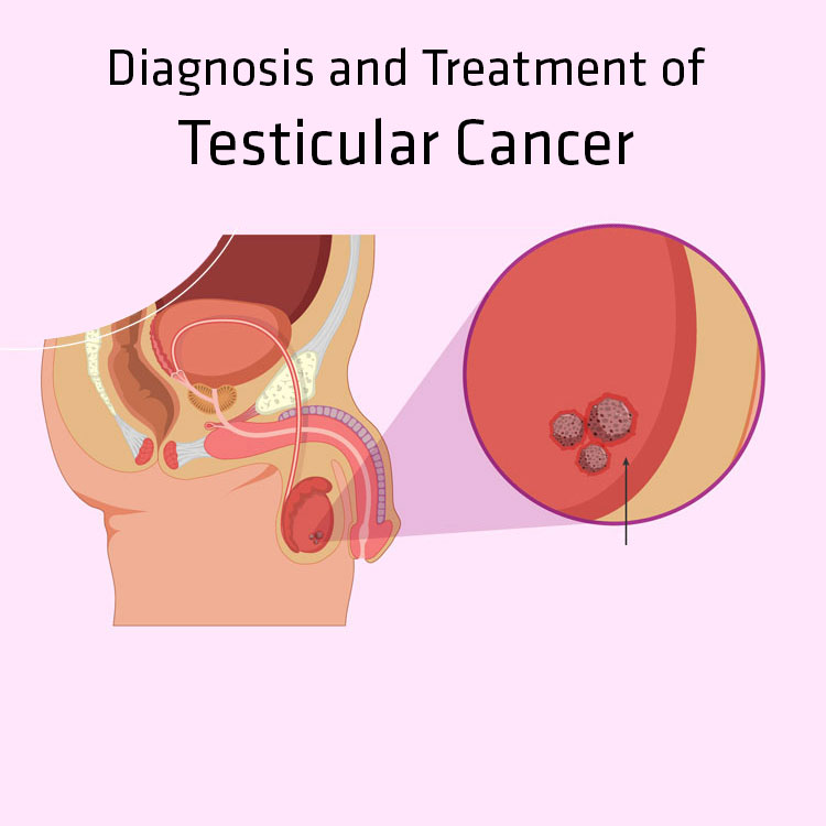 Diagnosis and Treatment of Testicular Cancer