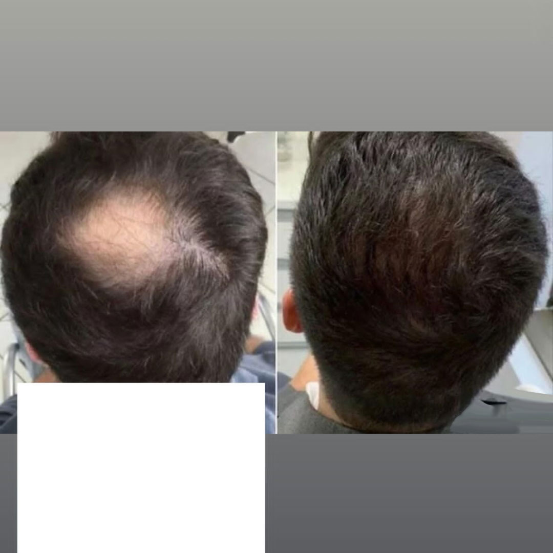Men’s head microblading head hair