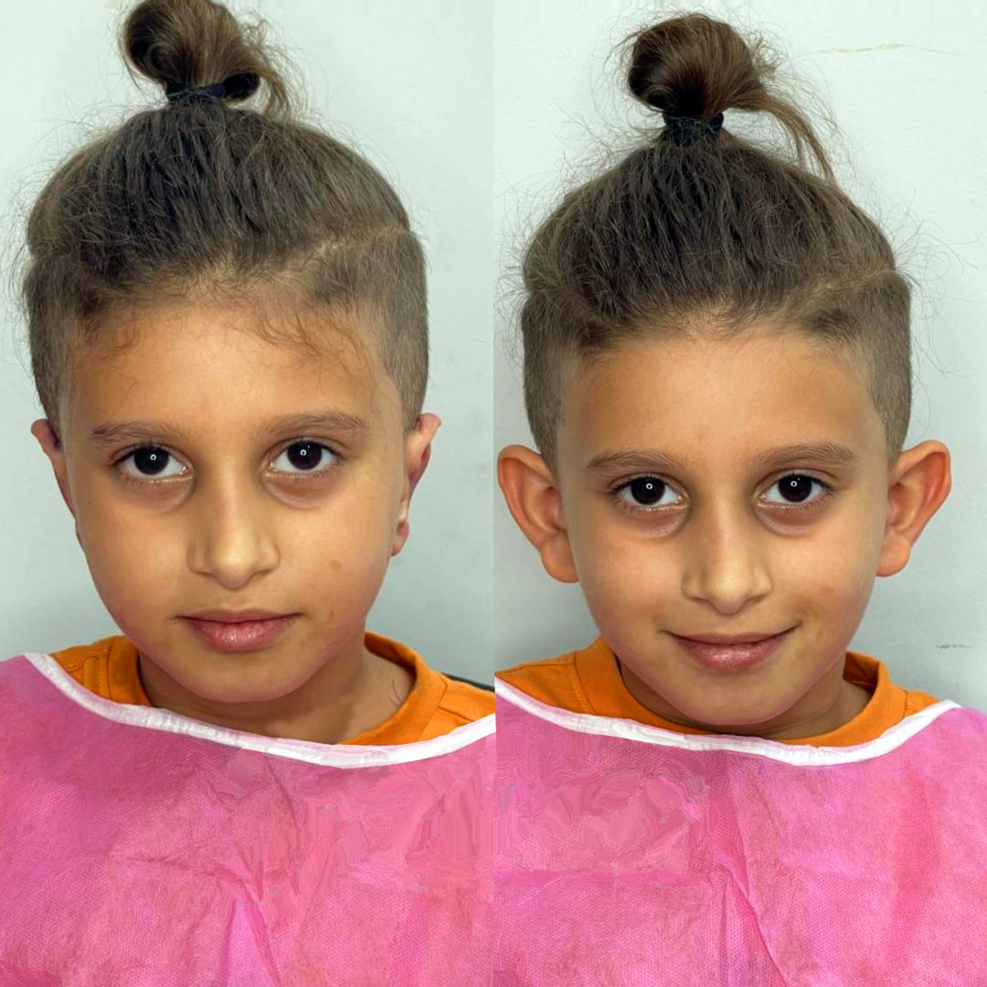 Otoplasty before and after for kids