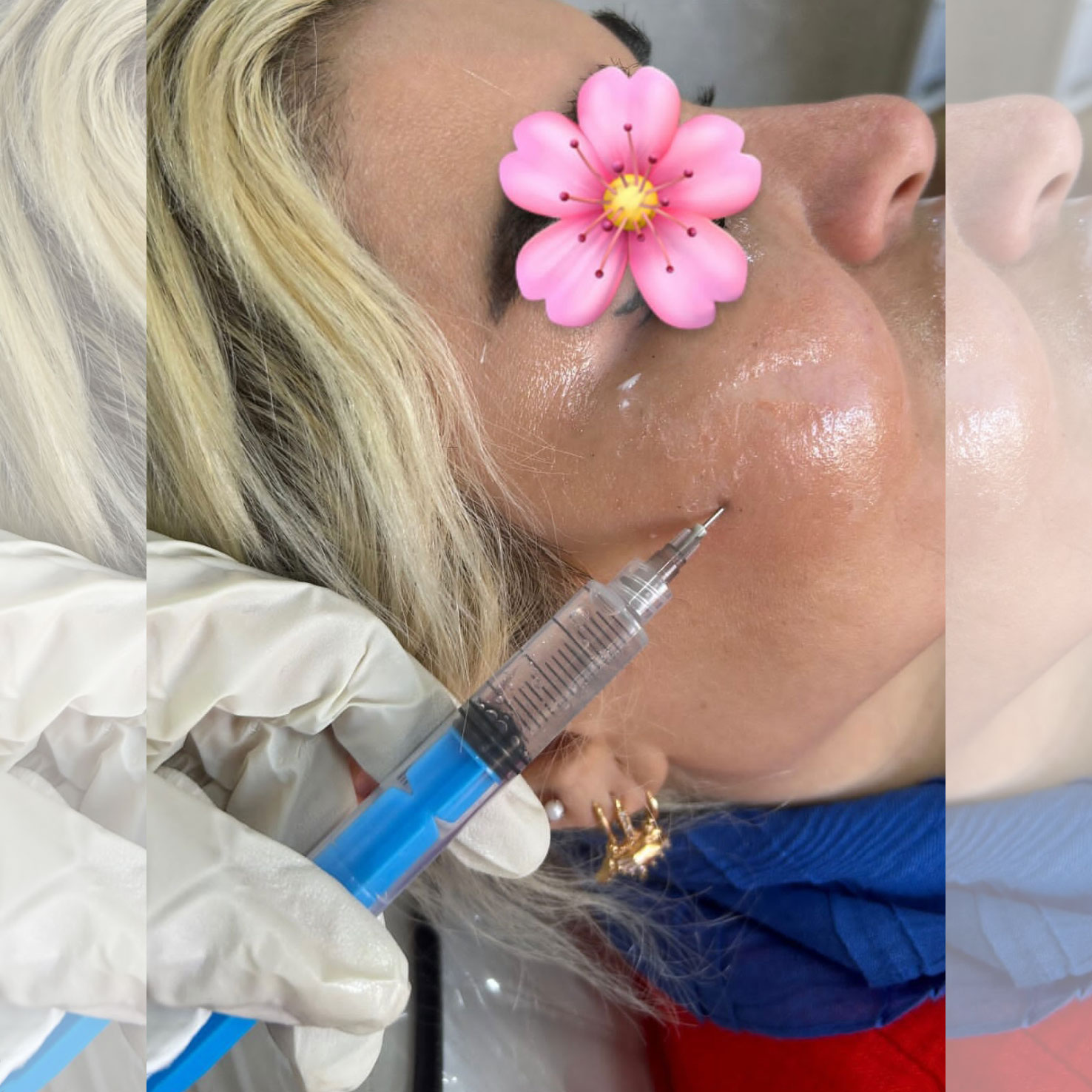 Removing dermal PAAG fillers with enzyme injections