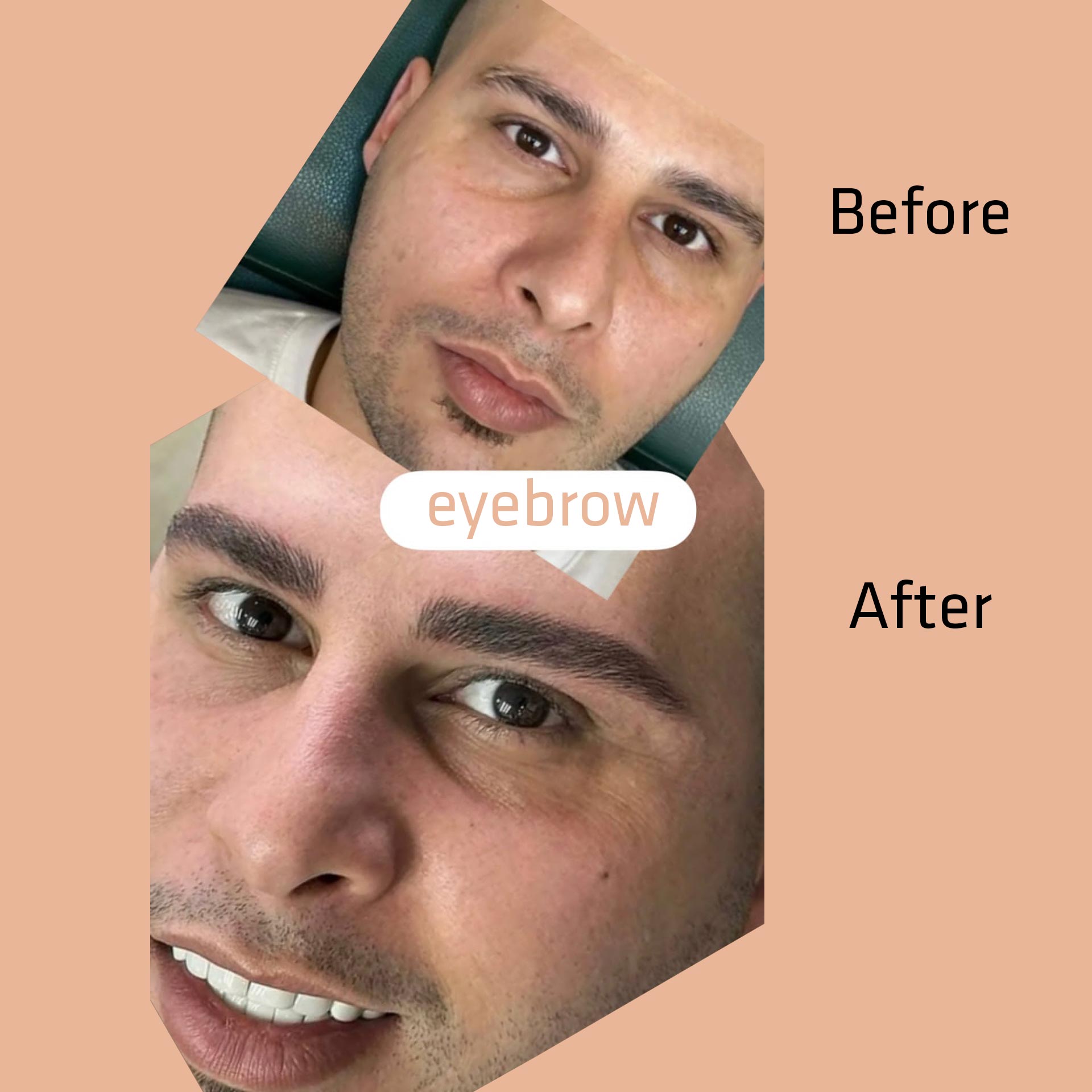 Side effects of eyebrow microblading
