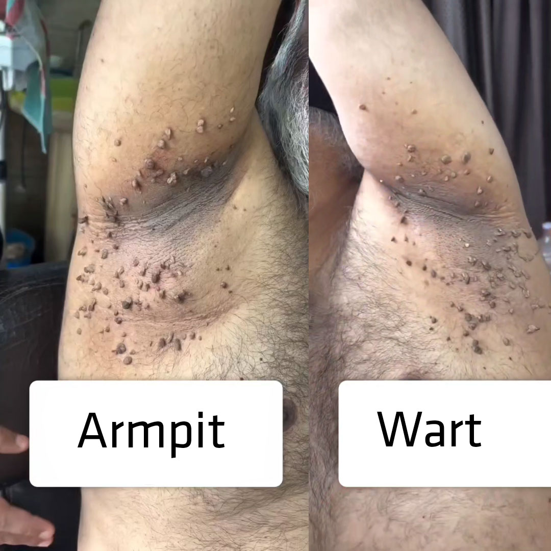 What are armpit warts ? + Photos in men