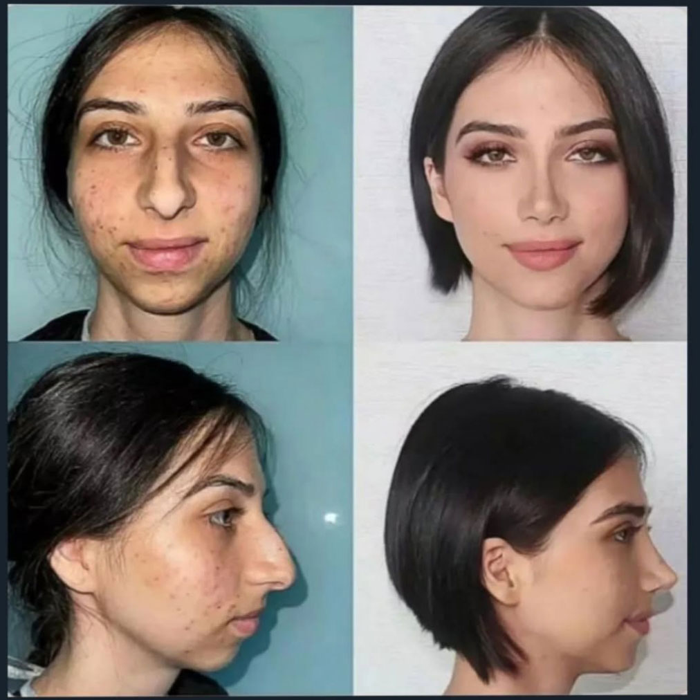 Women’s facial plastic surgery before and after – The biggest facelift surgery