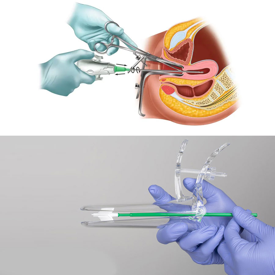 Can a Pap smear be done with a hymen ?