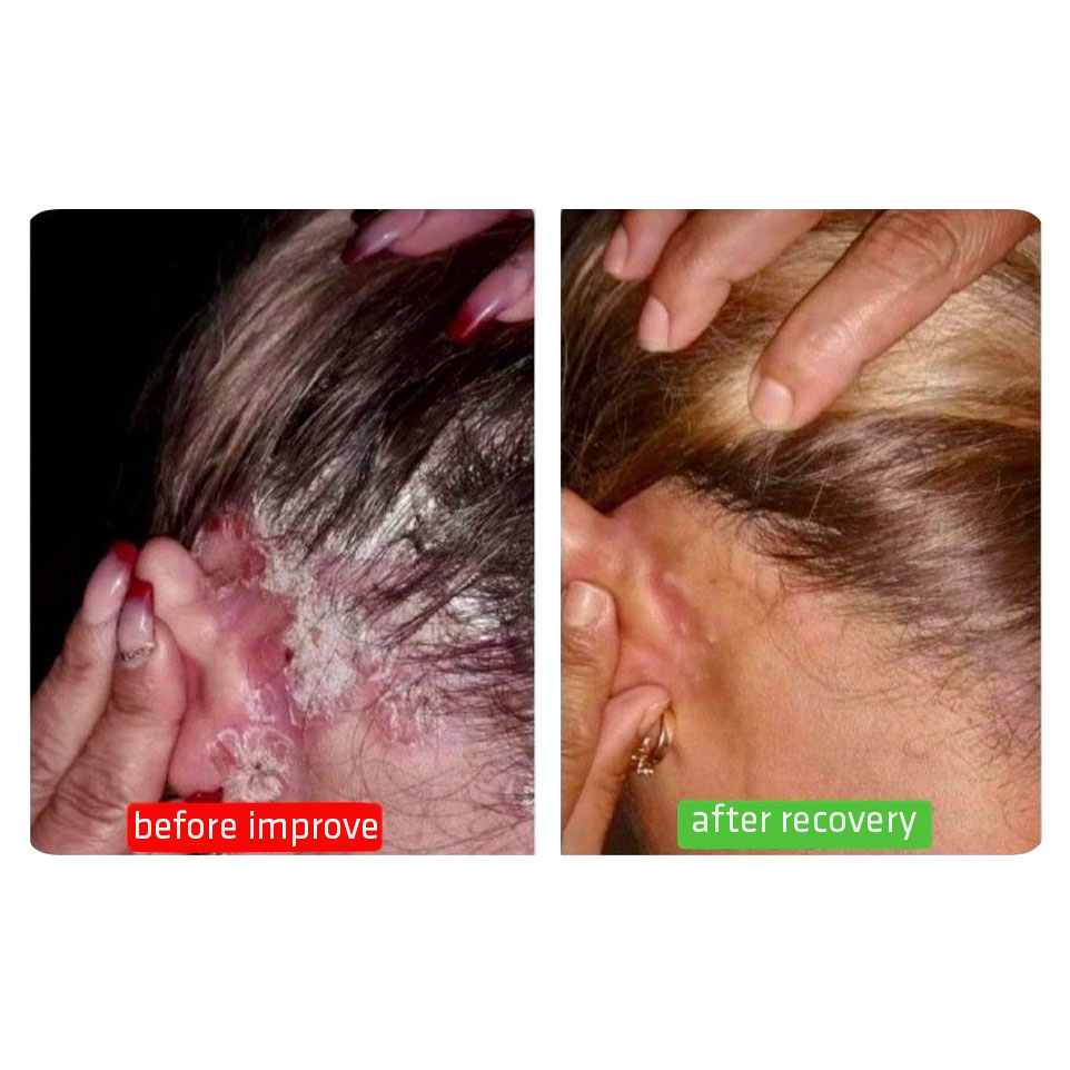 scalp psoriasis photo + before improve and after recovery