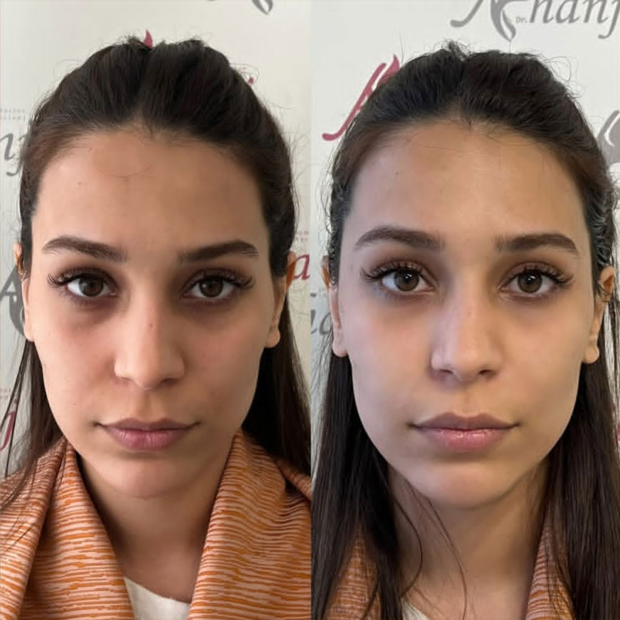 what is enzyme injection ?