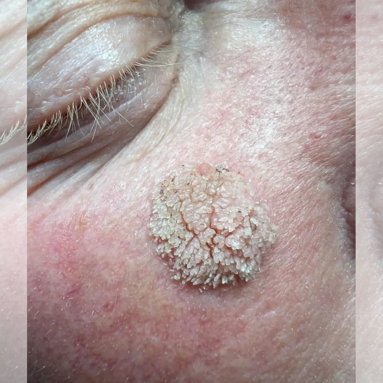 elephant form wart on the face on the cheek under the eye